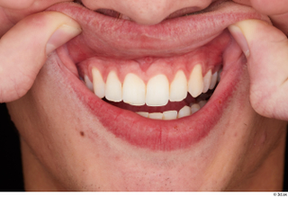 Alessandro Katz teeth 0002.jpg